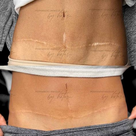 Transform Your Tummy Tuck Scar with Our Camouflage Tattoo